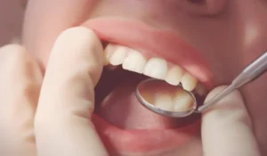 GSD-Composite-Fillings-Better-Alternative-to-Amalgam-BLOG-04